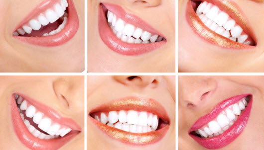 Should Know About Teeth Whitening